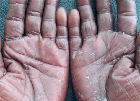 Palmar Erythema - Pictures, Symptoms, Causes, Treatment