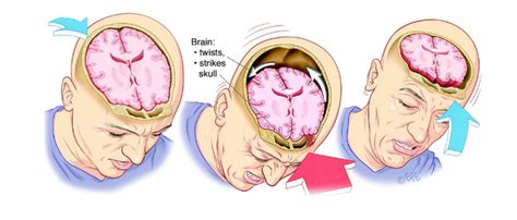 Chronic Traumatic Encephalopathy - The Brain Clinic