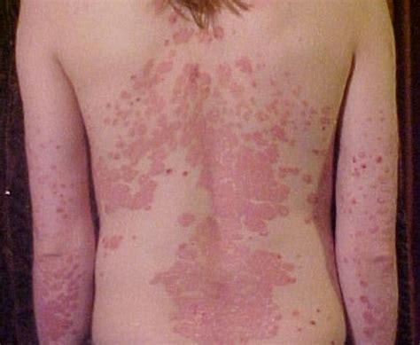 Psoriasis Skin Rash On Face