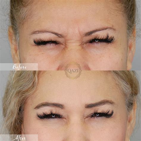 Best Botox in Orange County, CA | Qazi Cosmetic Center