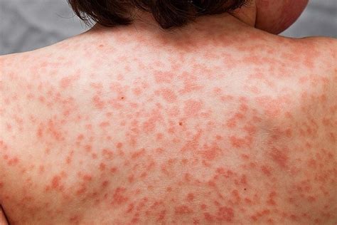 Viral Skin Rash Adult