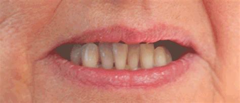 Milford Dentists | Dentures