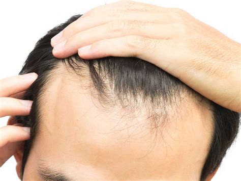 The Receding Hairline Stages for Men & Women – DS Healthcare Group