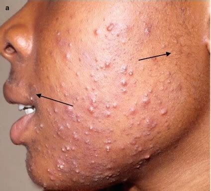 Comedonal acne: Causes, treatment, prevention - Iya Magazine