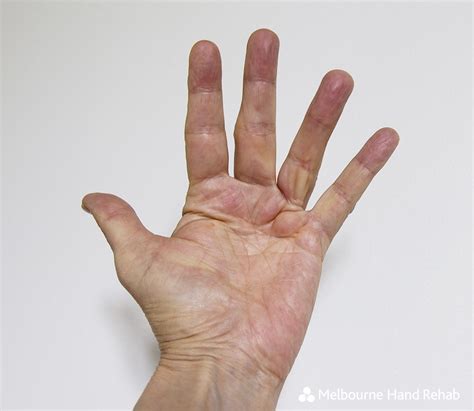 Dupuytren’s Disease Treatment | Melbourne Hand Rehab