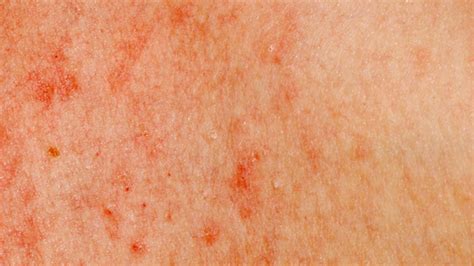 Blood Cancer Skin Rash