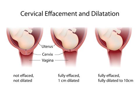 Cervical Effacement: What You Need to Know