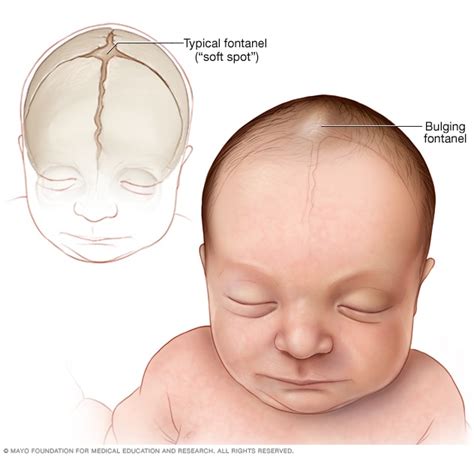 Bulging fontanel - Mayo Clinic