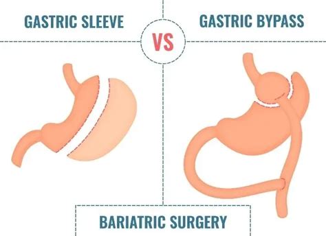 Gastric Sleeve Vs. Gastric Bypass: What’s The Difference | Bariatric ...