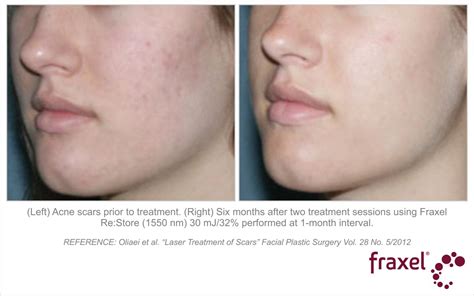 Fraxel Results - Fraxel