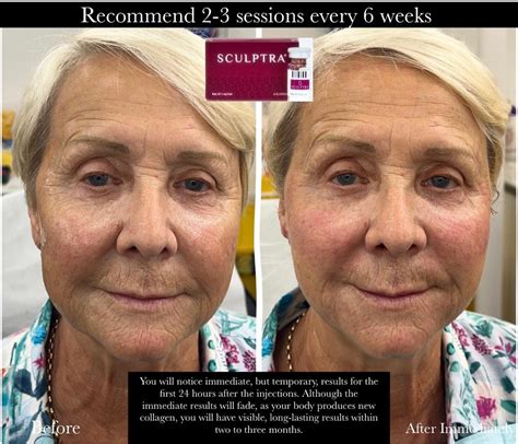 Sculptra Before and After | Real-Life Transformations