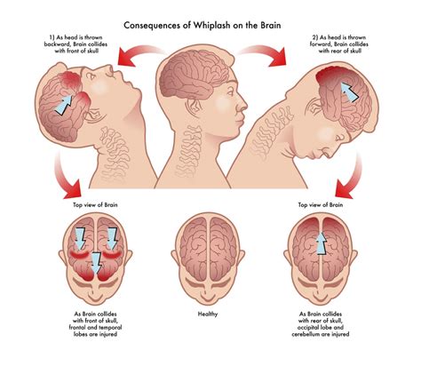 Whiplash | Advanced Training and Rehab