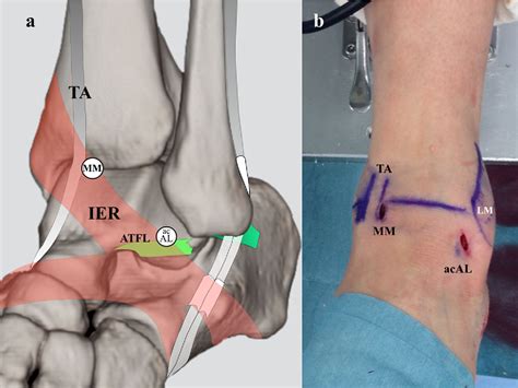 Inferior extensor retinaculum | Semantic Scholar