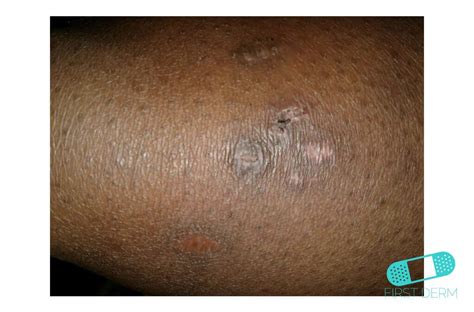 What Is The Icd 10 Code For Hyperpigmentation Back