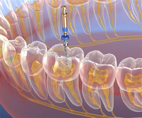 Root Canal Pain Relief | Penn Dental Family Practice