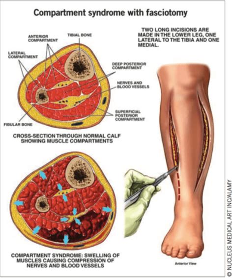 Is delta pressure accurate for compartment syndrome? - County EM