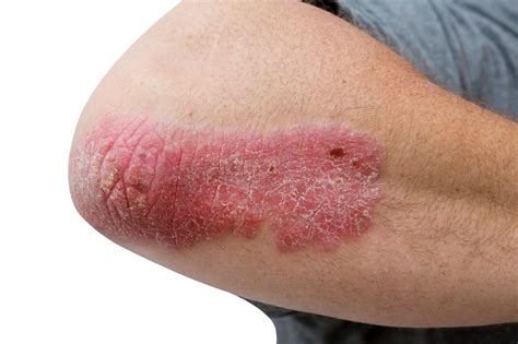 Deucravacitinib Therapy May Address Plaque Psoriasis When Apremilast Fails - Dermatology Advisor