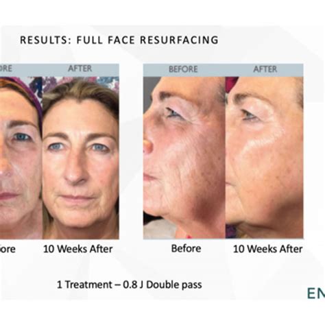 Non Surgical Facelift Near Me | Plano, TX | Facelift Near Me