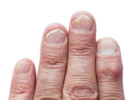 Psoriatic nail disease has many clinical signs. | Psoriatic arthritis, Psoriatic, Nail psoriasis ...