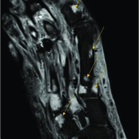 MRI of the right foot -shows diffuse soft tissue swelling with mild... | Download Scientific Diagram