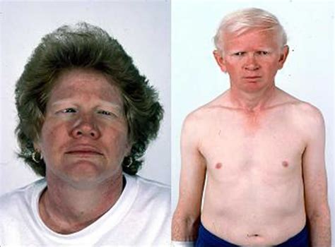 Hermansky Pudlak syndrome, causes, symptoms, diagnosis, treatment & prognosis