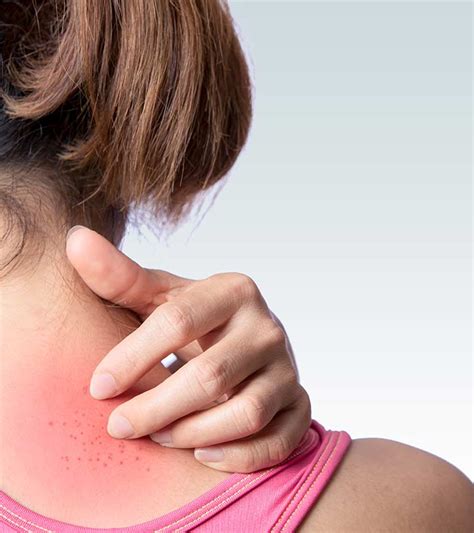 Heat Rash In Adults: Causes, Treatment, And Prevention Tips