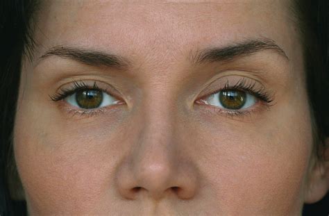 What is ocular ptosis, and how can you treat it? - IRIS