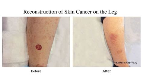 What Is a Split-Thickness Skin Graft? | Dr. Hung