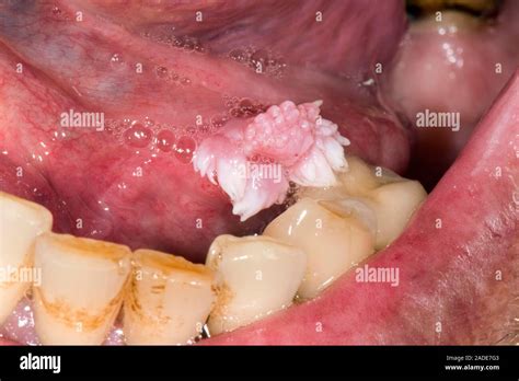 Mouth wart. Papilloma (wart) on the oral mucous surfaces in the mouth ...