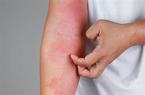 Penyakit Kulit Psoriasis – newstempo