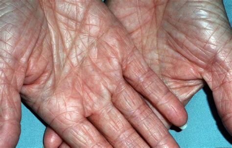 Ichthyosis Vulgaris - Causes, Symptoms, Complications & Treatment