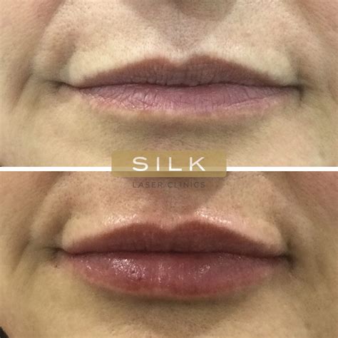 Lip Fillers - Lip Care Specialist - SILK Laser Clinics