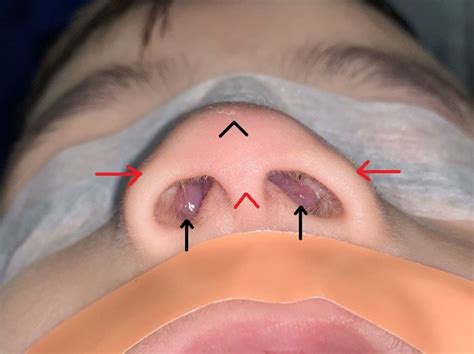 Inferior turbinate hypertrophy presenting as bilateral nasal masses in ...