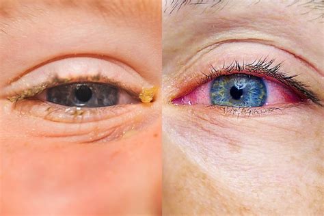 Viral vs. bacterial pink eye - Little Health Care