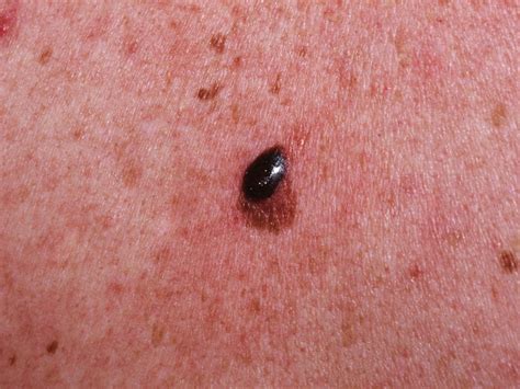 What’s new in the latest melanoma guidelines | MDedge Internal Medicine