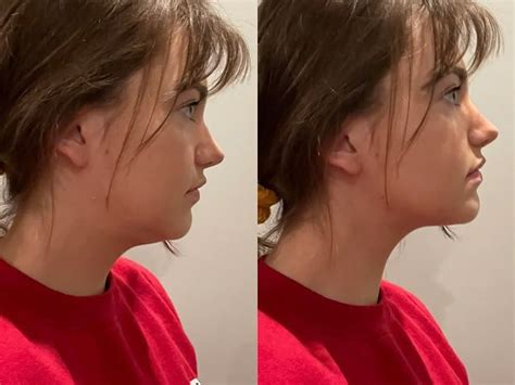 Are Double Chins Genetic? Get Rid of Genetic Double Chin Naturally!