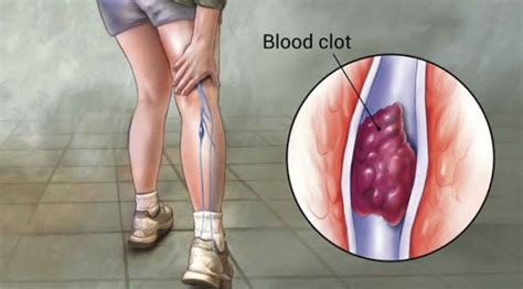 Thrombus definition, thrombus formation, mural thrombus