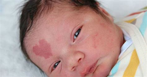 Baby Boy Born With A Heart-Shaped Birthmark On His Forehead