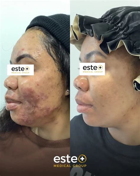 Inflamed Adult Acne Completely Cleared Up! - Este