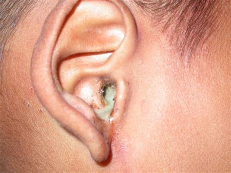 What causes odorless Clear Discharge from Ear - HealthPulls