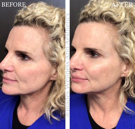 Lip & Sculptra Injections Cypress - Restylane Filler Cypress | Blades Wellness Cypress, TX