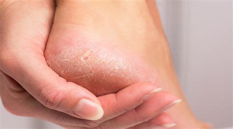 Causes & Treatment for Dry and Cracked Skin | Advanced Foot & Ankle