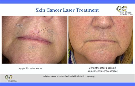 Skin Cancer Laser Treatment - Skin Cancer Clinic Melbourne