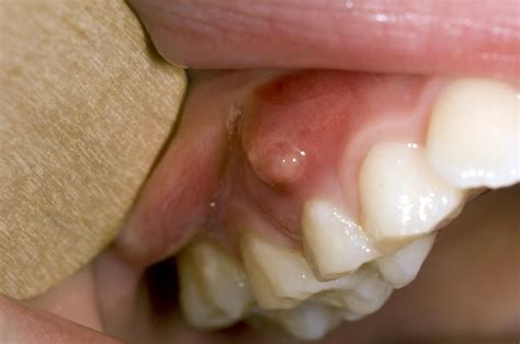 Gum boils: What they are and how to treat them (2022)