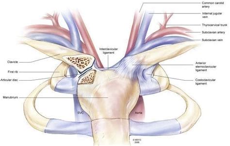 Sternoclavicular Joint Dislocation • LITFL • Trauma library