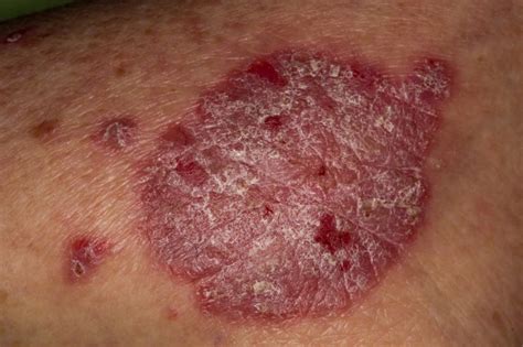 Certolizumab Pegol Effective for Moderate to Severe Chronic Plaque Psoriasis - Dermatology Advisor