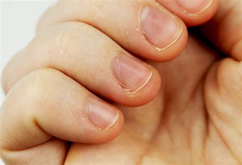 What Causes Little White Spots On Nails - Design Talk