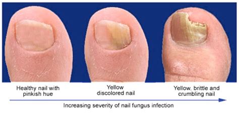 Mild Toe Fungus Treatment