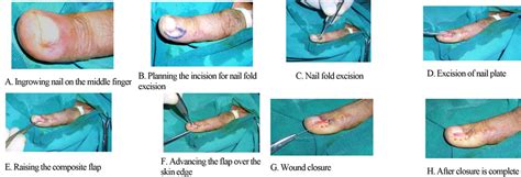 Ingrowing Nail Correction by Advancing Composite Flap of the Nailbed and Periosteum—A Simple and ...