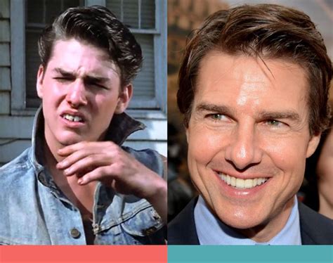 Tom Cruise Braces Before After. Hollywood's best smiles #Dentalcare # ...